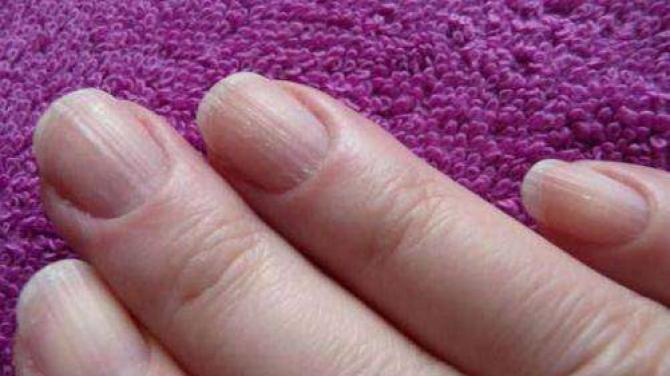 Почему на ногтях появляются продольные или поперечные полоски?