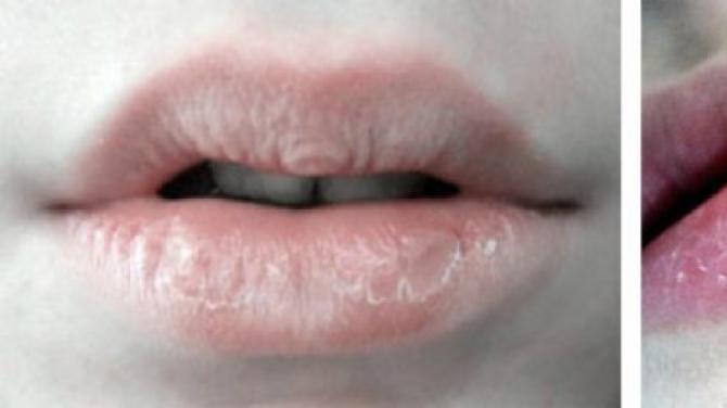 Что делать, если шелушатся и трескаются губы, и почему это происходит?