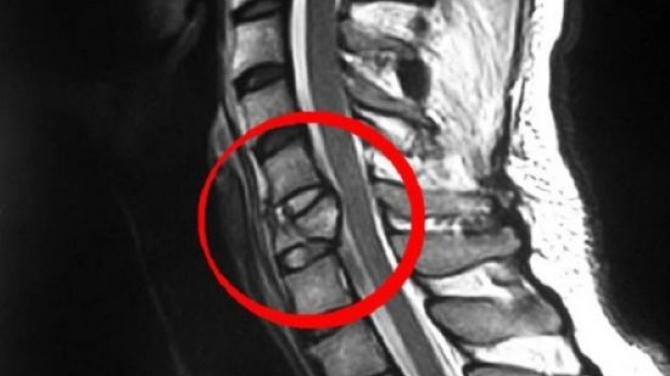 Защемление нерва в шейном отделе. Компрессионный перелом позвонка мрт снимок. Смещение позвонков шейного отдела мрт. Смещение позвонков шейного отдела рентген. Смещение позвонков рентген.